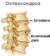 остеохондроза на хомеопатията на шийния гръбначен стълб